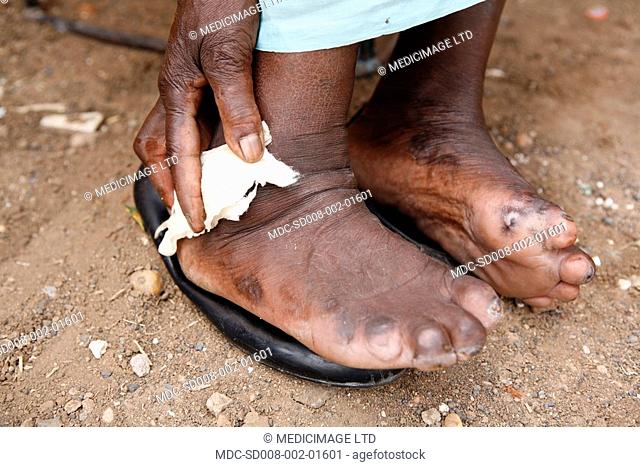 An elderly woman places a small bandage on an ankle ulcer. The woman is suffering from leprosy, which has caused severe, irreversible damage to her feet and...