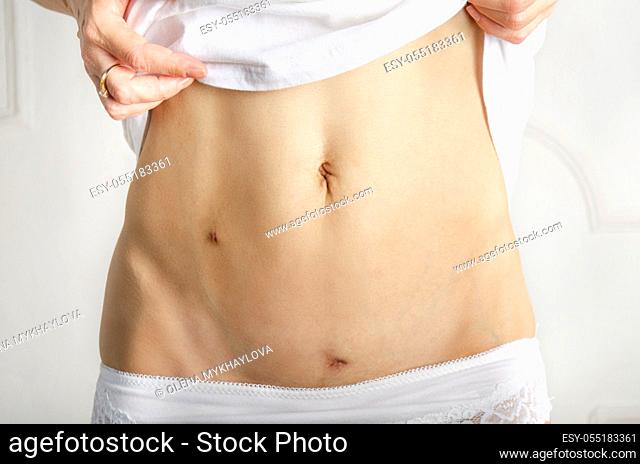 Middle age caucasian female shows her Healing scars after Laparoscopic Appendix Removal Surgery