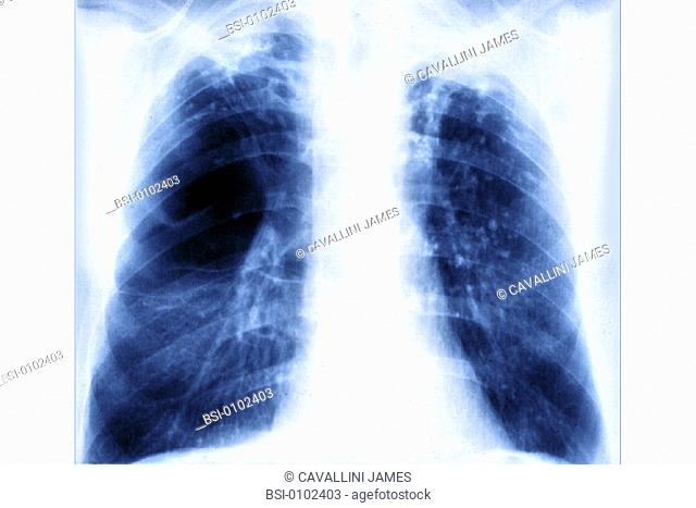 EMPHYSEMA LUNG RADIO<BR>Pulmonary emphysema is characterized by pulmonary alveola that are unable to completely deflate (hyperinflation)