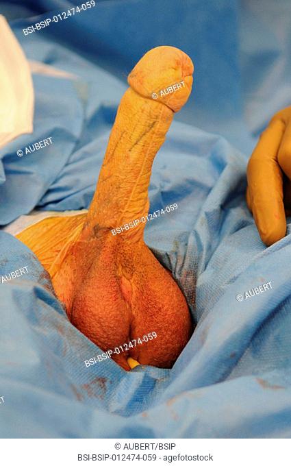 Photo essay at Lyon hospital. Department of urology. Phalloplastie, operation of plastic surgery to create a phallus, required to complete a change of sex