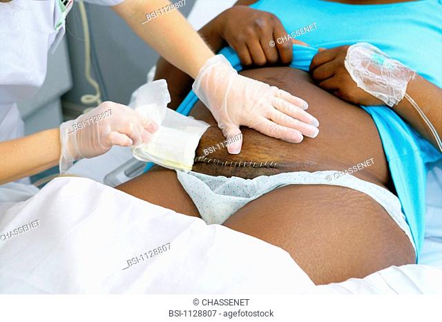 NURSE DISPENSING CARE Photo essay from hospital. Change of the cesarean scar dressing 2 days after the intervention