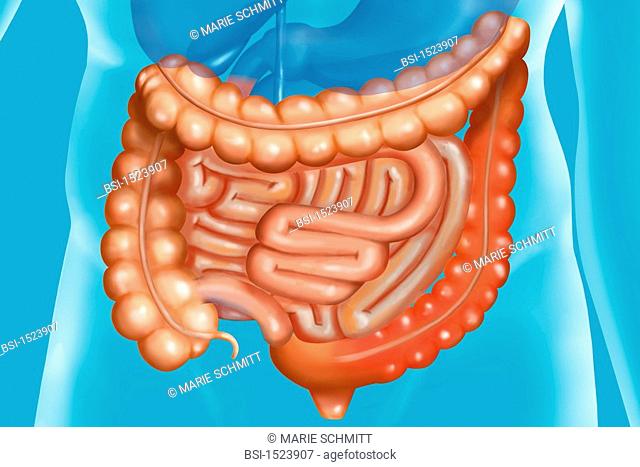Sigmoiditis is an inflammation of the sigmoid colon. It is generally the consequence of a diverticulosis, presence of diverticula on the colon mucosa