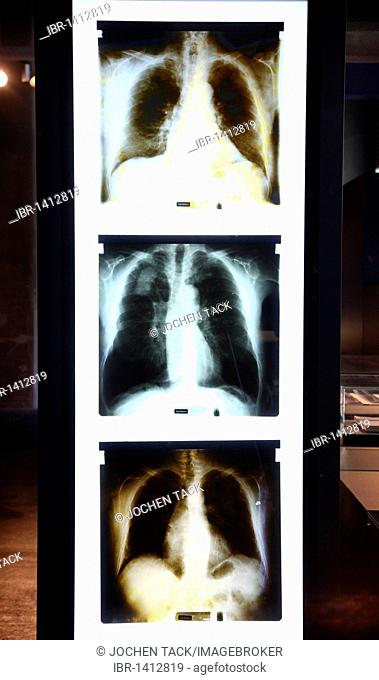 X-rays of miners' lungs, so-called black lung, Coalworker's pneumoconiosis, in the new Ruhrmuseum museum, opened in January 2010, Capital of Culture year