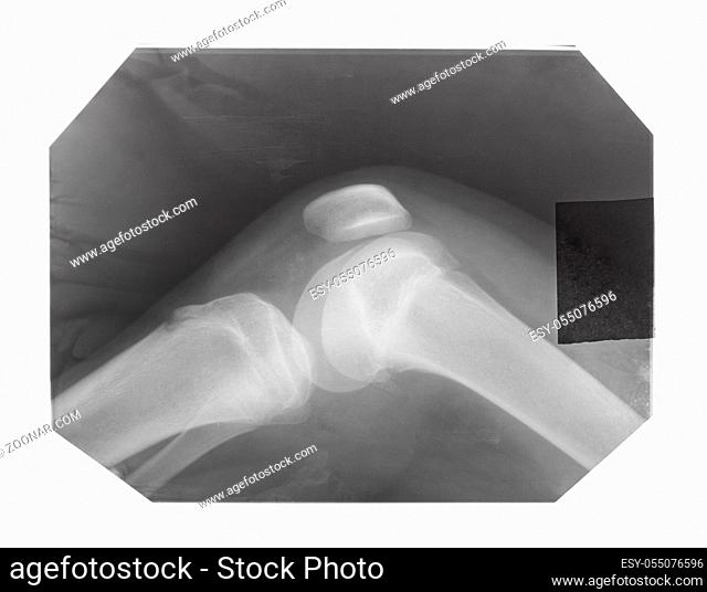 film with X-ray image of human knee-joint with kneecap isolated on white background