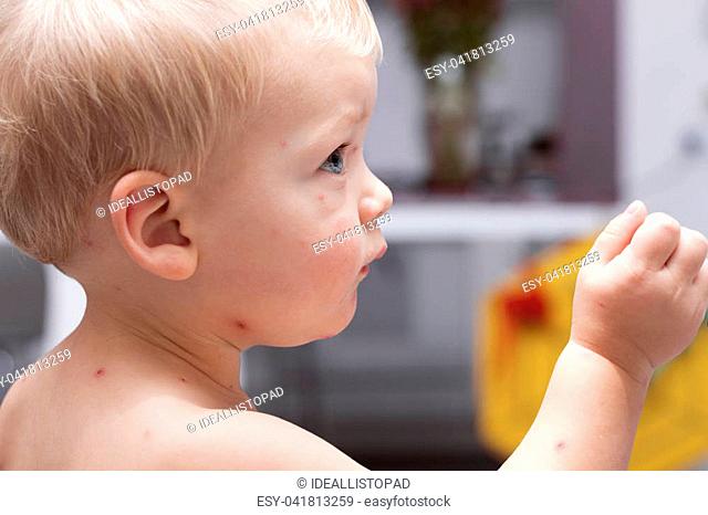 Portrait of cute toddler with chickenpox. Funny baby boy with varicella