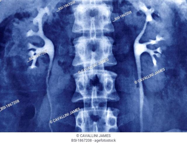 KIDNEY, X-RAY Urography in front view, normal kidneys and ureters