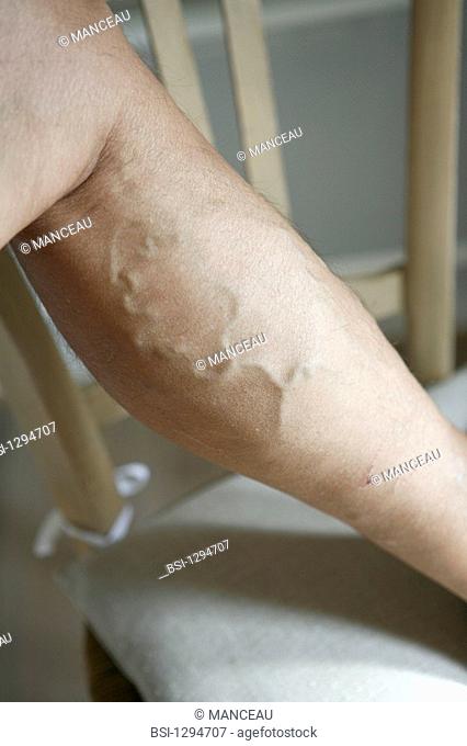 VARICOSE VEIN ON A LEG Troncular vein on the left leg. The troncular varicose veins are the ones developping on the trunk of the saphenous veins, knurled aspect