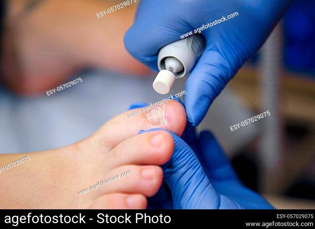 Podology treatment. Podiatrist treating toenail fungus. Doctor removes calluses, corns and treats ingrown nail. Hardware manicure