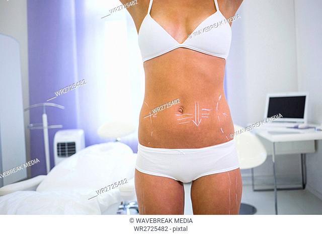 Female body with the drawing arrows for abdomen for liposuction and cellulite removal