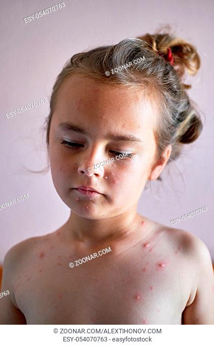 Portrait of a lovely 6 years old little girl with chickenpox