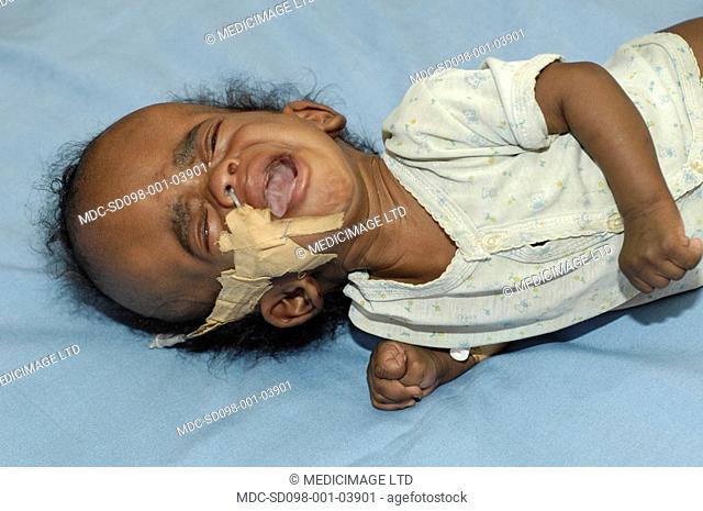 A small child suffering from hydrocephalus, a condition in which excessive Cerebrospinal fluid CSF production leads to a build up of pressure within the brain