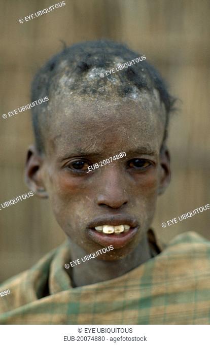 Severely malnourished boy at CONCERN feeding centre