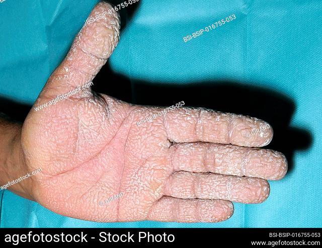 Second-degree burns of the hands by caustic soda in a 35-year-old man