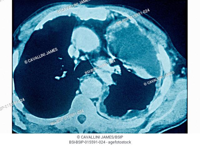 Lung cancer caused by asbestosis, seen on a radial section CT chest scan