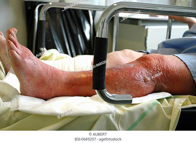 ERYSIPELAS Photo essay from hospital. Emergency services. Woman with a dermatosis on the left leg : erysipelas. Erysipelas is an bacterial infectious pathology...