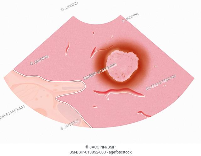 Illustration of the ablation of a tumor in the liver by radiofrequency ablation. Within a few minutes the tumor has been destroyed and the electrode can be...