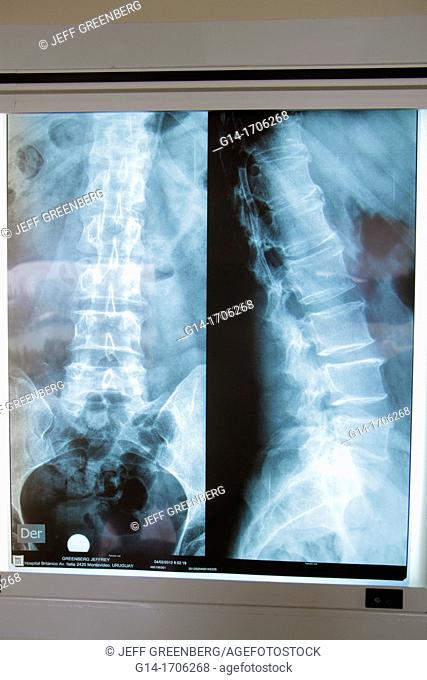 Florida, Miami Beach, Mount Mt  Sinai Medical Center, centre, hospital, x-ray, xray, male, spinal column, pelvis