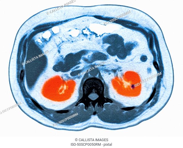 CT scan of abdomen with small kidney stone