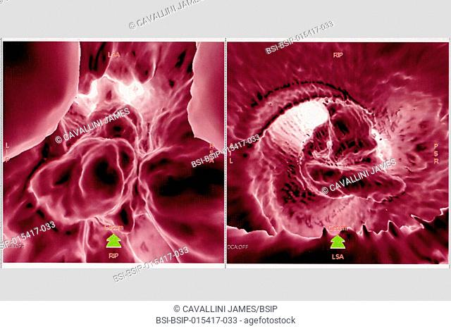 Colon cancer (tumors on the caecum). Visualisation using 3D reconstruction from a CT scan (virtual coloscopy)