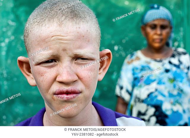 Albino boy with his mother ( Ethiopia)