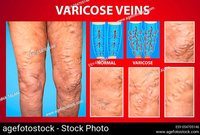 The old age and sick of a woman. Varicose veins on a legs of woman. The varicosity, spider veins, edema, illness concept