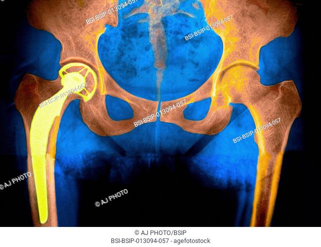 Hip prothesis of a 65-year old woman