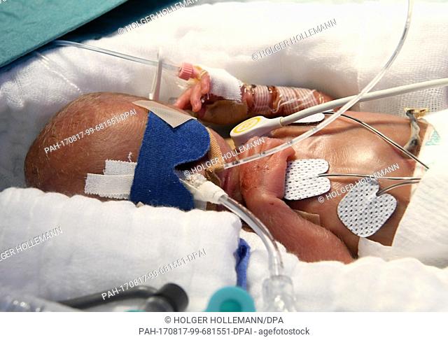 A 5-day-old boy who weighed 430 grams at birth, in an incubator at the children's clinic of Hannover Medical School (Medizinische Hochschule Hannover