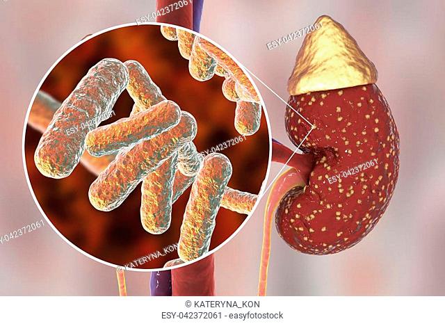 Pyelonephritis, medical concept, and close-up view of bacteria, the common causative agent of kidney infection, 3D illustration