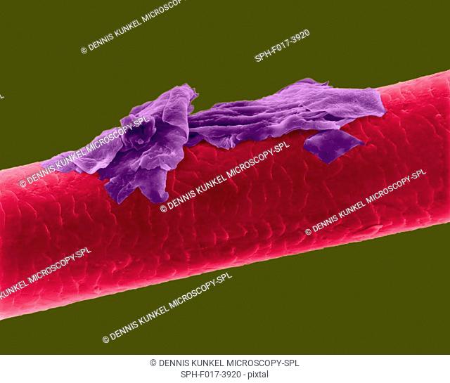Human hair with dandruff, coloured scanning electron micrograph (SEM). The outer layer of hair (the cuticle) has overlapping scales of keratin