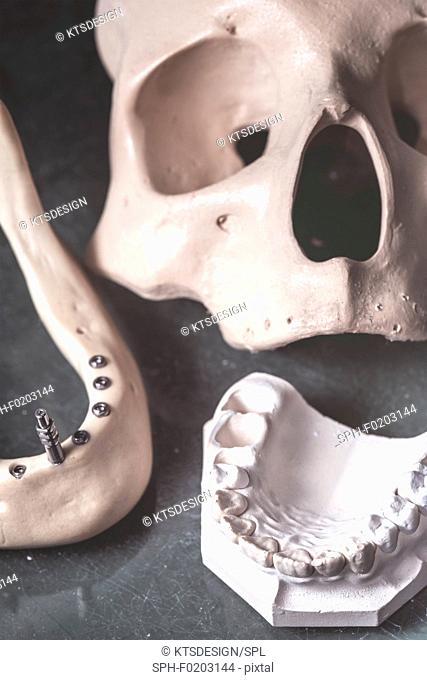 Dental prosthesis and jaw with skull