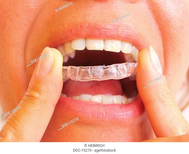 Bruxismus - to step by the crunching with the teeth bruxism - the mostly unconscious nocturnal crunching with the teeth - in most blemish loads cases of the...