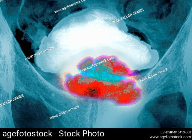 Prostate cancer seen by frontal pelvic x-ray