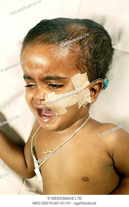 Close up of a small child suffering from hydrocephalus, a condition in which excessive Cerebrospinal fluid CSF production leads to a build up of pressure within...