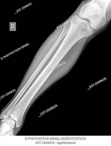 X-ray of the lower leg 50 year old male with a fractured tibia side view
