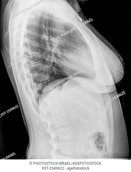 Chest x-ray of a 27 year old female suffering from Bronchitis. side view