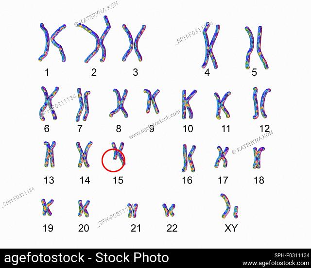 Karyotype of Angelman syndrome (AS), computer illustration. AS is a genetic disorder characterised by arm flapping, excessive laughing (even when hurt)