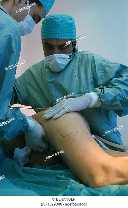 LIPOSUCTION<BR>Photo essay from clinic.<BR>Haussmann Courcelles Clinic