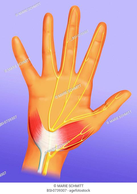 Carpal tunnel. On the palmar face of the wrist we can observe an anatomical tunnel called carpal tunnel. The tendons and the median nerve slip throught this...
