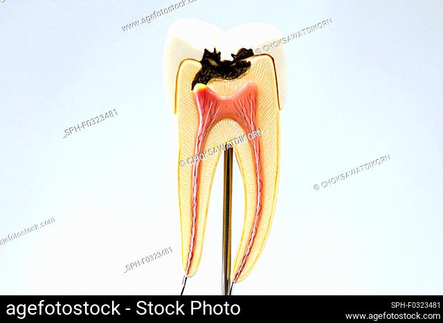 Tooth decay model