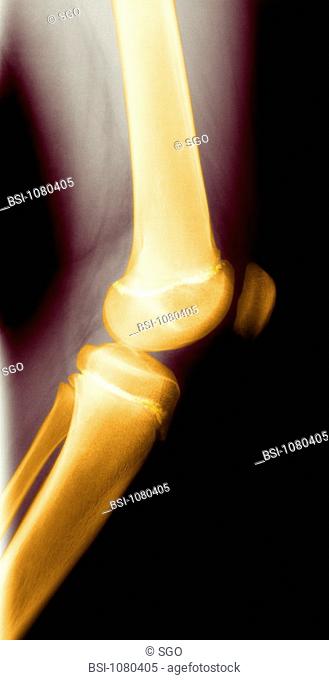 KNEE, X-RAY<BR>Epiphyseal cartilage of the femur and tibia, in white. This cartilage plays a vital role during bone growth