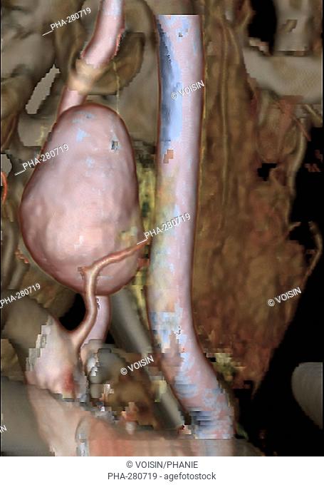 Vertebral artery aneurysm, 3D CT-Angiography