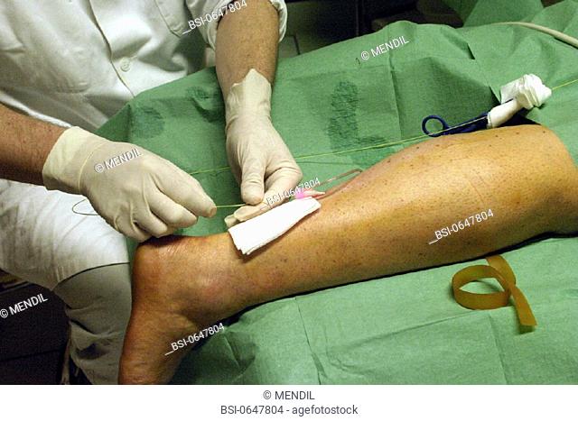 VARICOSE VEIN, SURGERY<BR>Photo essay from hospital.<BR>Insertion of laser fiber