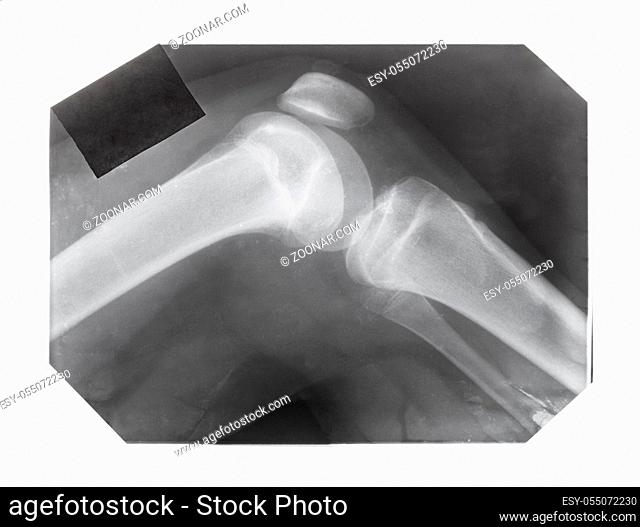 film with X-ray image of human knee joint with patella isolated on white background