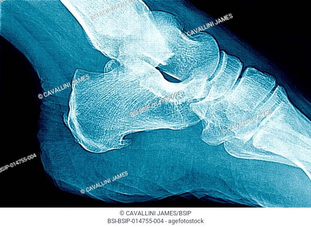 Ensethopathy of the supeficial plantar fascia. Sagittal section x-ray of the foot