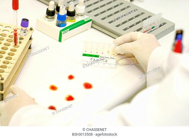 BLOOD GROUP Photo essay from laboratory. Determination of blood group ABO on plate ABO grouping and cartridge of red cell antibodies