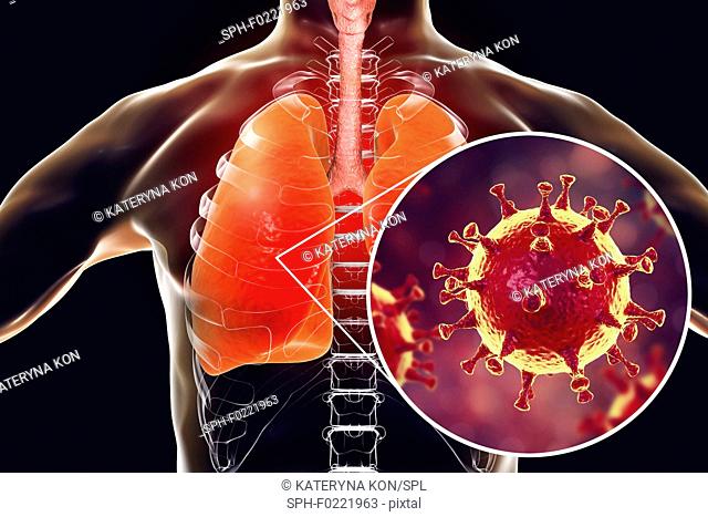 MERS virus infection of lungs, conceptual illustration