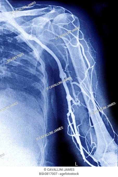 Phlebography of the veins of the left arm, without pathology x-ray with an injection of a contrast media. On the internal face of the arm, the subclavian