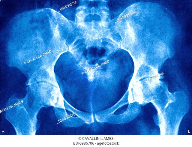 Arthritis of the hips. Coxofemoral deformations due to rhumatism provoking important coxalgia. X-ray of the hips in front view