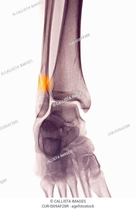 ankle x-ray showing fractured distal fibula