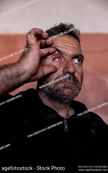 14 March 2023, Syria, Mashhad Ruhin: Ibrahim Serjawi, 47, shows the eye he lost in an air strike on the city of Marat Al-Numan, at the Mashhad Ruhin camp